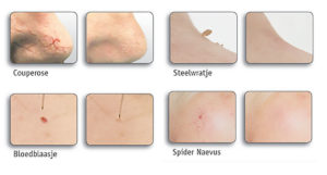 Bloedblaasjes verwijderen Skinclinic Nijmegen - Resi Peters